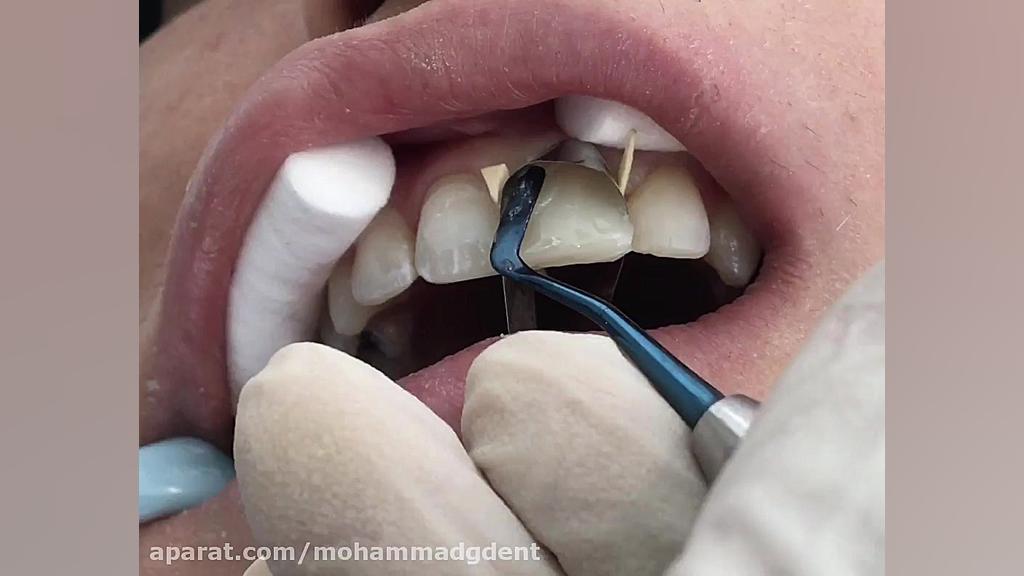 کامپوزیت ونیر دندانهای قدامی قسمت دوم ( دکتر قربانیان ) رزولین