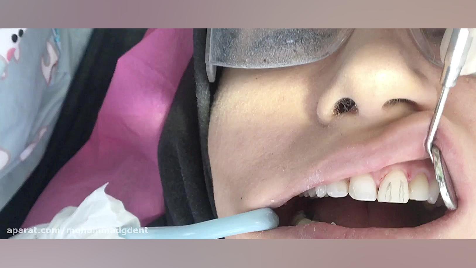 کامپوزیت ونیر دندانهای قدامی قسمت پنجم ( دکتر قربانیان ) هایپرپاراتیروئیدیسم