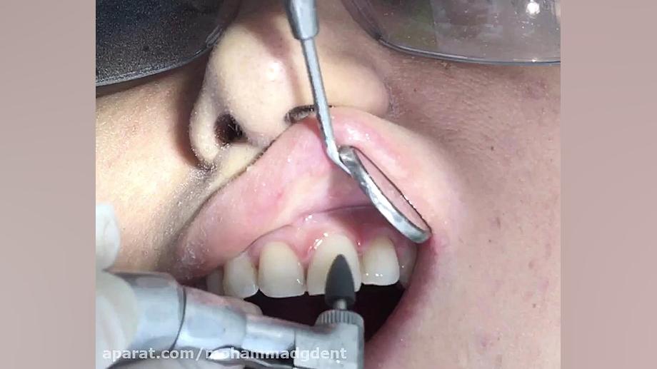 کامپوزیت ونیر دندانهای قدامی قسمت ششم ( دکتر قربانیان ) تست تحریک ACTH