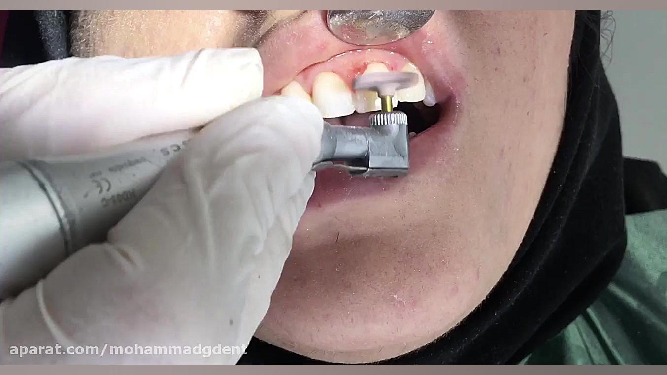 کامپوزیت ونیر دندانهای قدامی قسمت هفتم ( دکتر قربانیان ) پزشکی شخصی‌سازی‌شده سطح یاخته‌ای