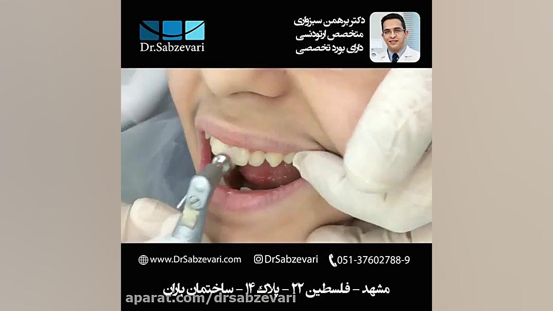 آغاز درمان ارتودنسی ثابت (۱) : تمیز کردن سطح دندان ها دکتر برهمن سبزواری - متخصص ارتودنسی - مشهد