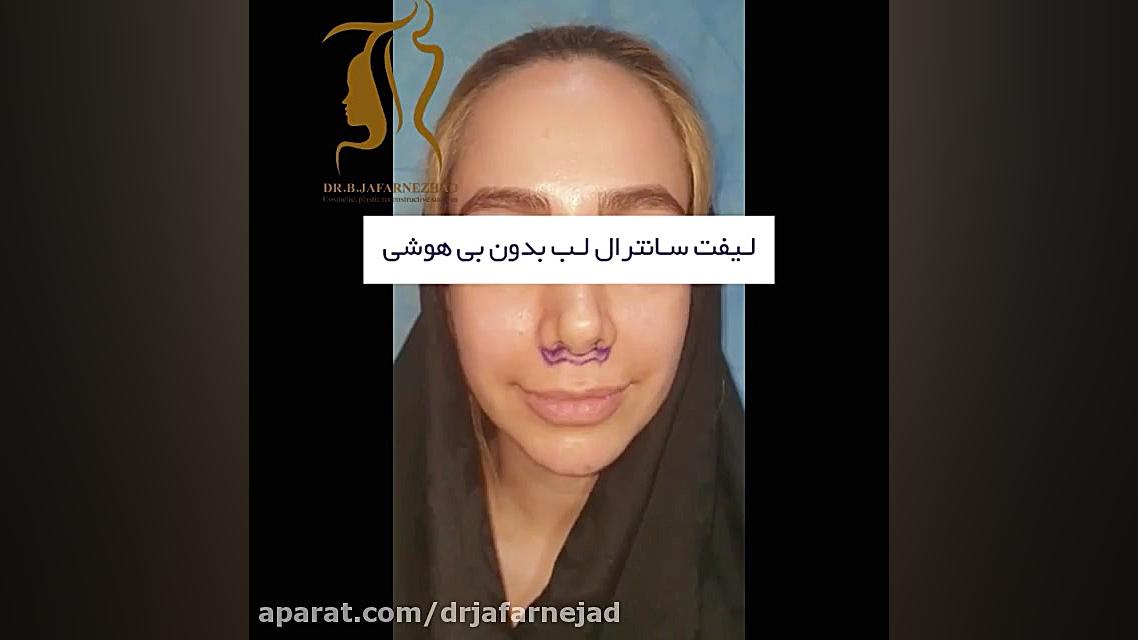 لیفت سانترال لب بدون بیهوشی دکتر بابک جعفرنژاد