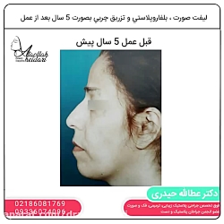 لیفت صورت، بلفاروپلاستی و تزری...
