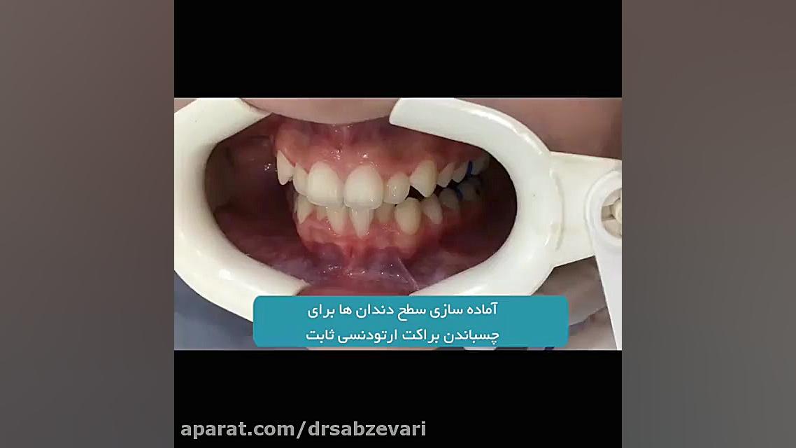 آغاز درمان ارتودنسی ثابت (۲) : آماده سازی سطح دندان ها برای براکت ارتودنسی دکتر برهمن سبزواری - متخصص ارتودنسی - مشهد