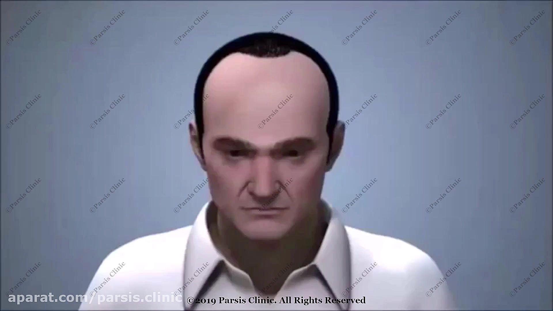 کاشت موی طبیعی به روش FUT کلینیک تخصصی پوست،زیبایی،لیزر و کاشت مو پارسیس