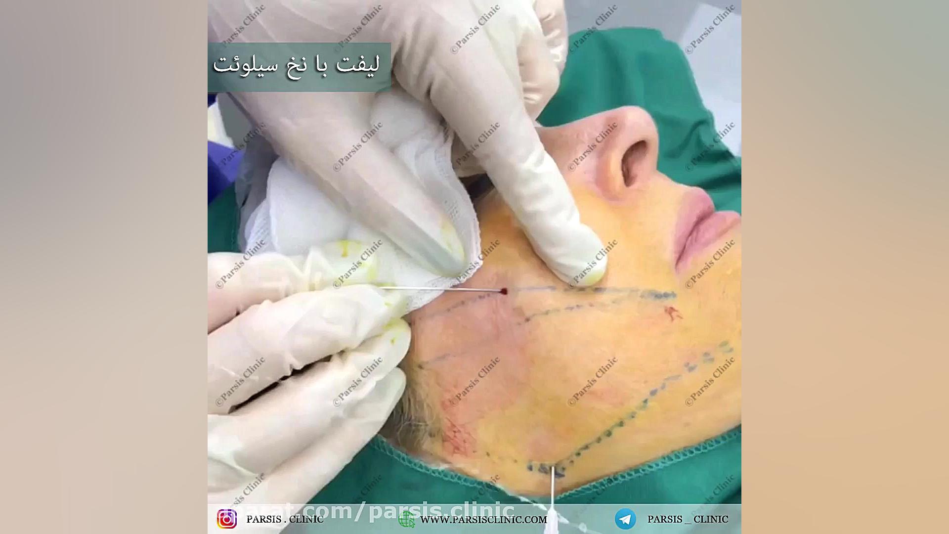 ليفت صورت با نخ سيلوئت امريكا کلینیک تخصصی پوست،زیبایی،لیزر و کاشت مو پارسیس