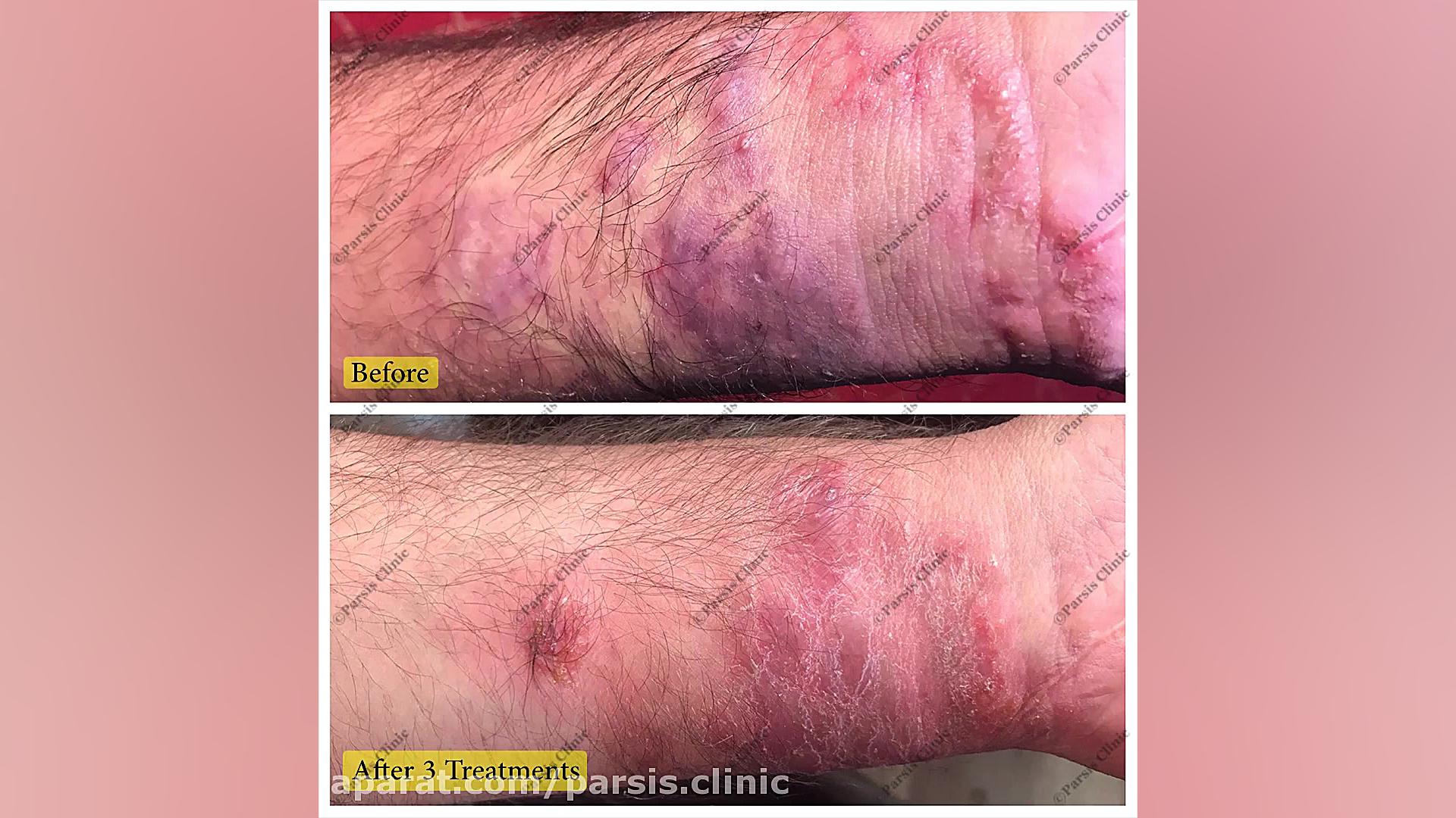 درمان بیمارى بیماری سالک کلینیک تخصصی پوست،زیبایی،لیزر و کاشت مو پارسیس