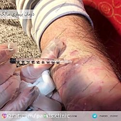 درمان بیمارى بیماری سالک