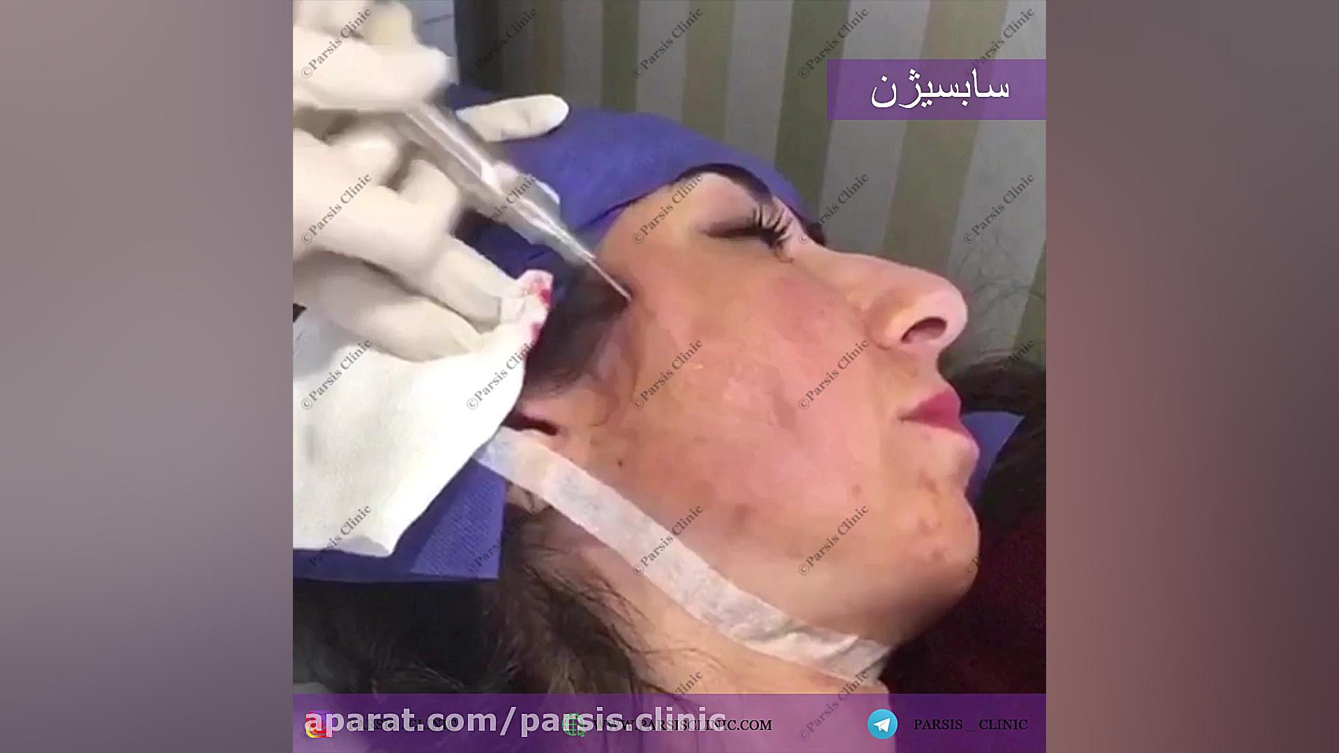 سابسیژن کلینیک تخصصی پوست،زیبایی،لیزر و کاشت مو پارسیس