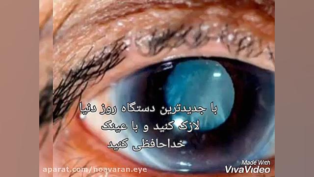 درمان آب سیاه (گلوکم) با دارو برداشتن خال