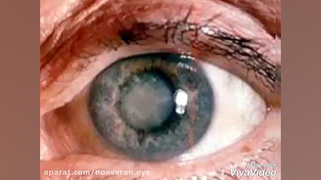 چه کسانی بیشتر در معرض آب سیاه (گلوکم) قرار دارند؟ بررسی لک صورت