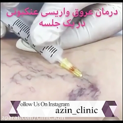 درمان عروق واریسی عنکبوتی در ی...