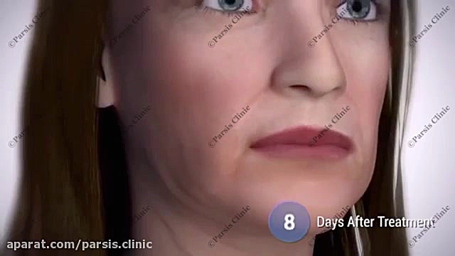 هایفوتراپی با دابلو - لیفت و جوانسازی صورت کلینیک تخصصی پوست،زیبایی،لیزر و کاشت مو پارسیس