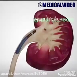 picture of kidney stones picture of kidney stones in urine