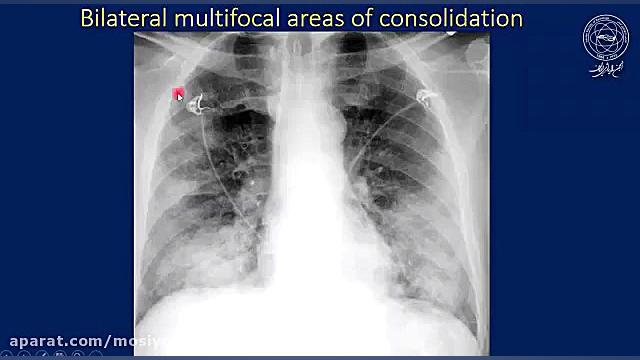 آموزش آسان تظاهرات کرونا در گرافی ساده قفسه سینه (CXR) لیفت گردنایمپلنت دندان
