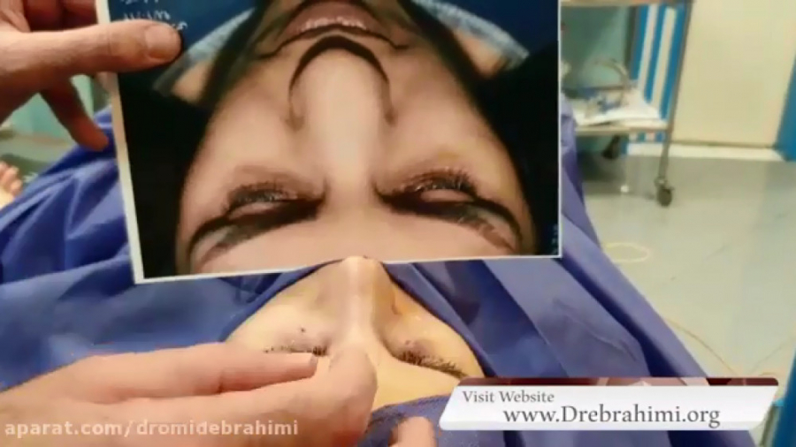 عمل بینی گوشتی پهن توسط بهترین جراح بینی گوشتی تهران دکتر امید ابراهیمی دکتر امید ابراهیمی
