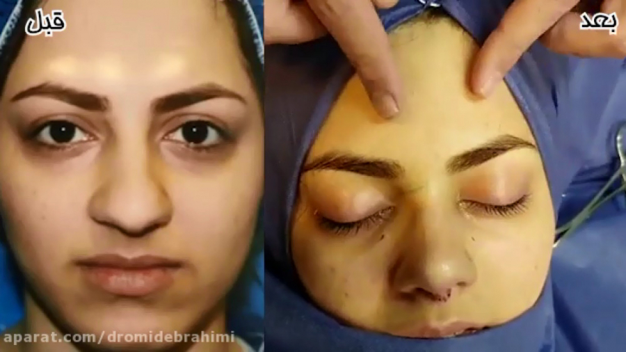 عمل بینی گوشتی توسط بهترین جراح بینی دکتر امید ابراهیمی دکتر امید ابراهیمی
