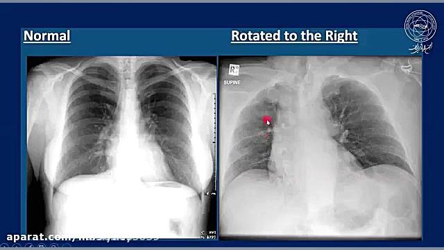 آموزش آسان تظاهرات کرونا در گرافی ساده قفسه سینه (CXR) لیزر موهای زائد