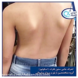 انحراف جانبی ستون فقرات