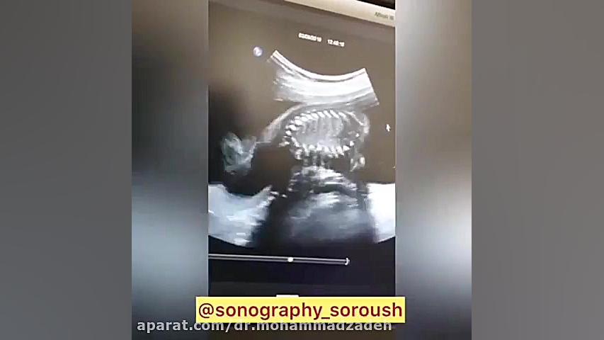 بررسی آنومالی اسکن جنین تنبان گشاد