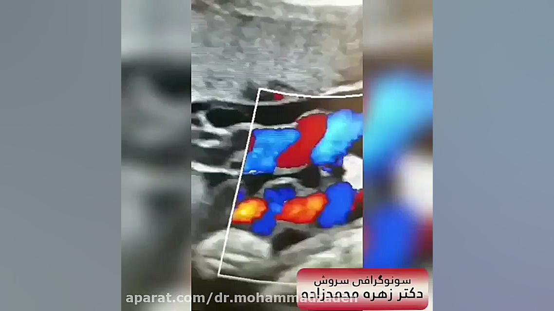 سونوگرافی کالرداپلر بند ناف جنین مد روز