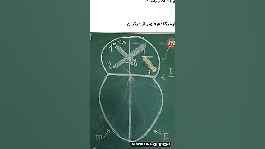 آموزش نوار قلب ECG به زبان ساده قسمت چهاردهم (آریتمی های قلبی ) کاشت ریش