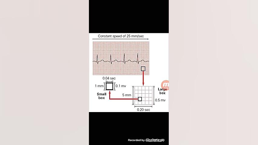 آموزش نوار قلب به زبان ساده ecg قسمت چهارم اصلاح طرح لبخند