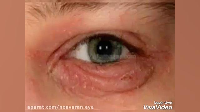 علائم و نشانه های بلفاریت : کاشت مو