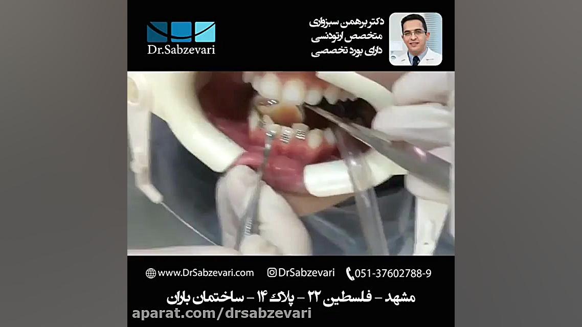 آغاز درمان ارتودنسی ثابت (۴) : ادامه مراحل چسباندن براکت ارتودنسی دکتر برهمن سبزواری - متخصص ارتودنسی - مشهد