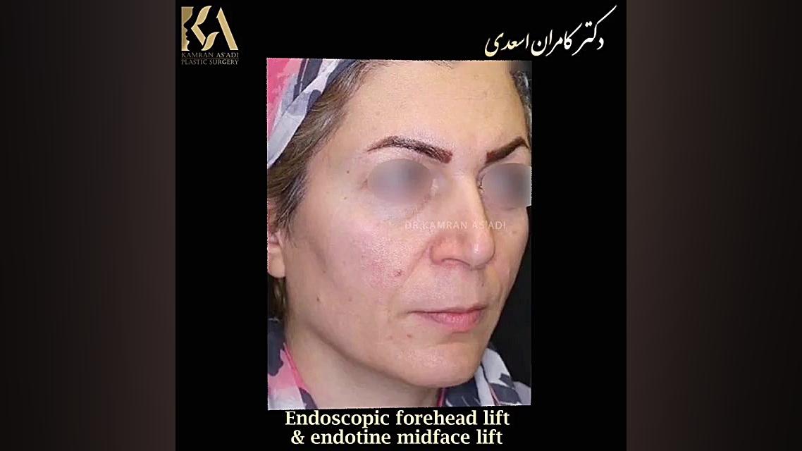 لیفت آندوسکوپیک پیشانی و بخش میانی صورت | دکتر اسعدی کابرگولین