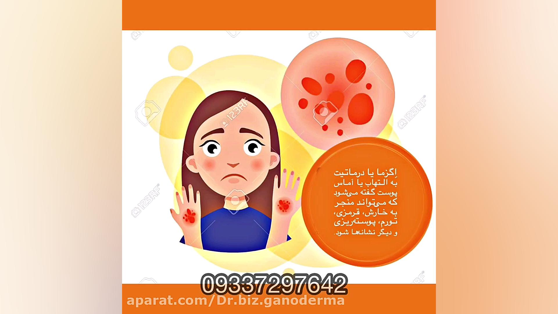 درمان بيماري اگزما لایک