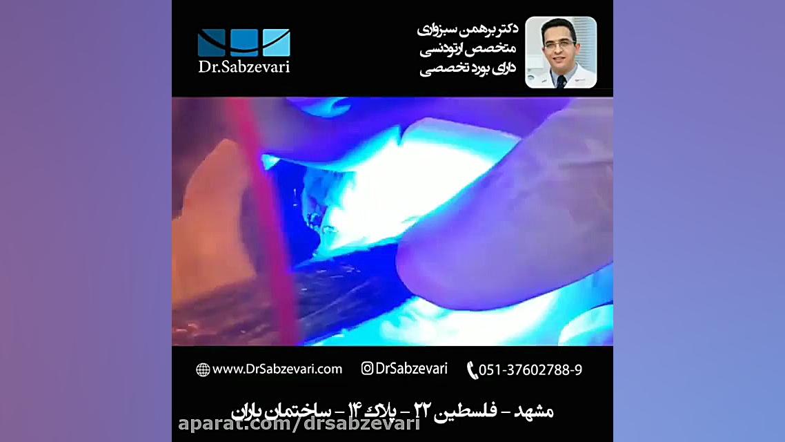 معرفی کش های جدا کننده دکتر برهمن سبزواری - متخصص ارتودنسی - مشهد