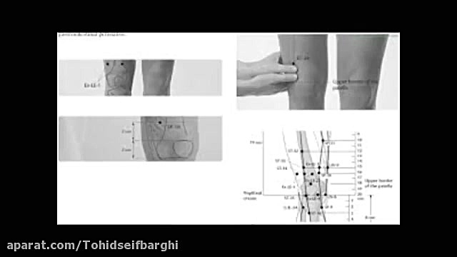 طب سوزنی در آرتروز زانو- دکتر توحید سیف برقی- قسمت 1 دندانپزشک زیبایی
