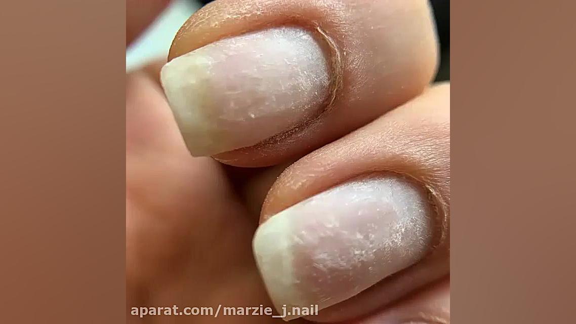 لمینت ناخن طبیعی پریودنتیکس