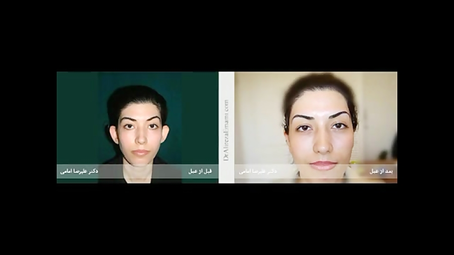 انمیشن جراحی گوش دکتر علیرضا امامی دکتر علیرضا امامی