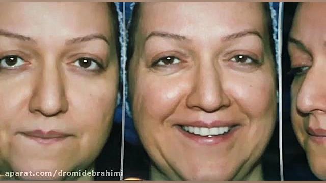 عمل بینی گوشتی توسط بهترین جراح بینی گوشتی تهران دکتر امید ابراهیمی دکتر امید ابراهیمی