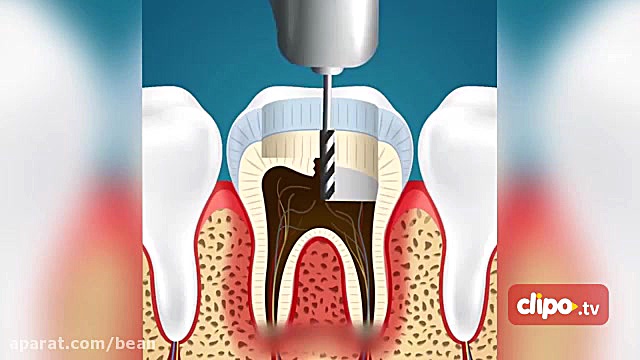 انیمیشن مراحل پر کردن دندان TEVAR