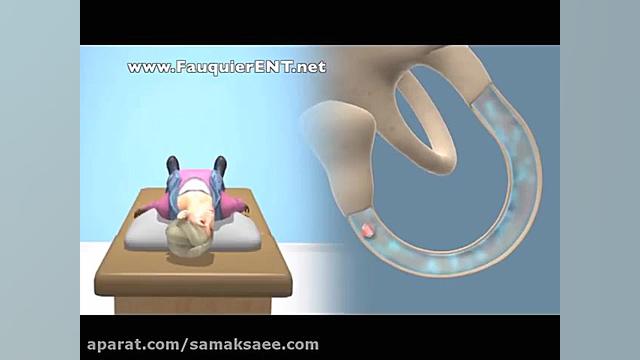 سرگیجه وضیعتی حمله‌ای خوش‌خیم کلینیک شنوایی و سمعک ساعی
