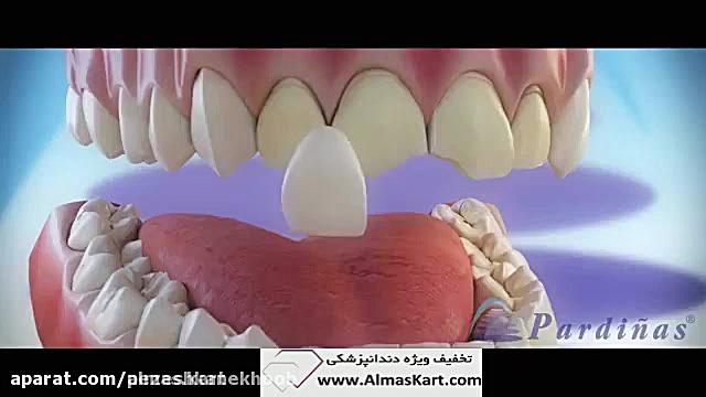 کامپوزیت دندان عمل زیبایی
