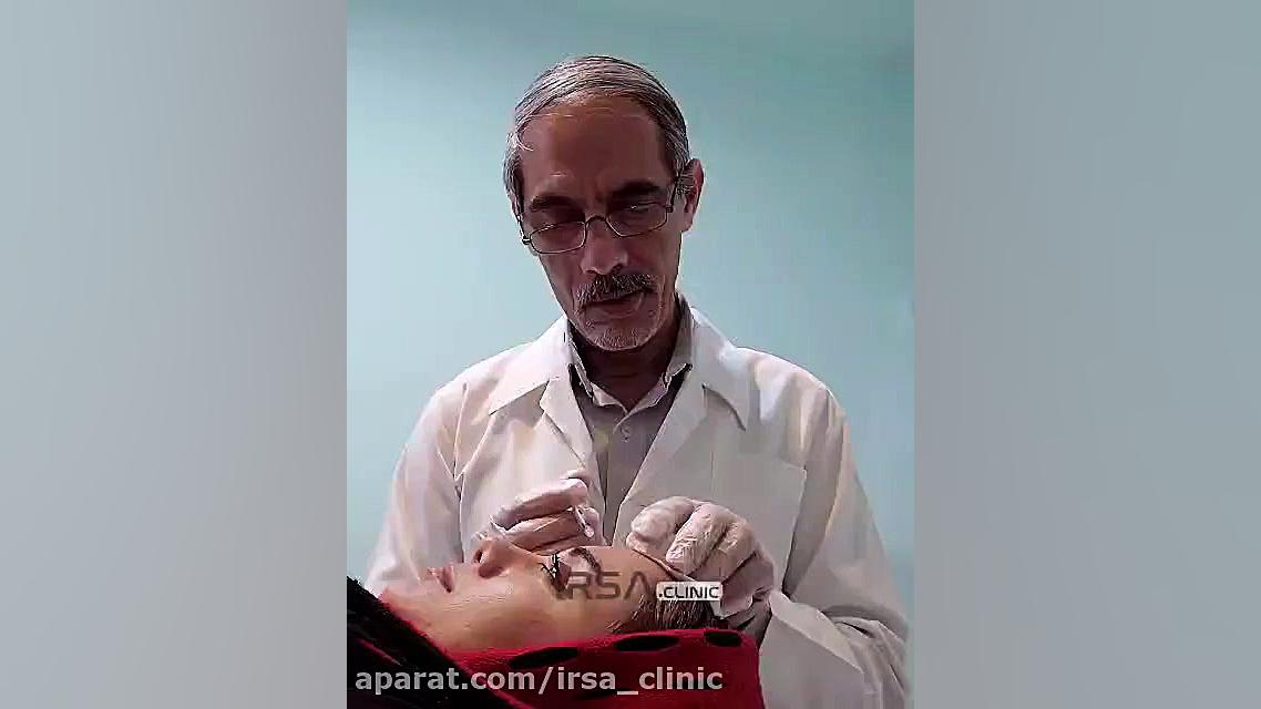 مزوتراپی به منظور درمان لکه های پوستی (کولاسما) آتپازیب