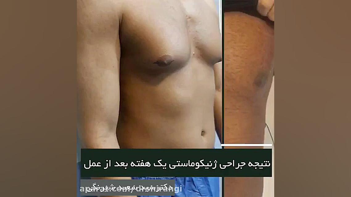فیلم واقعی جراحی سینه در مردان دکتر سعید شیرنگی (فوق تخصص جراحی پلاستیک و زیبایی)