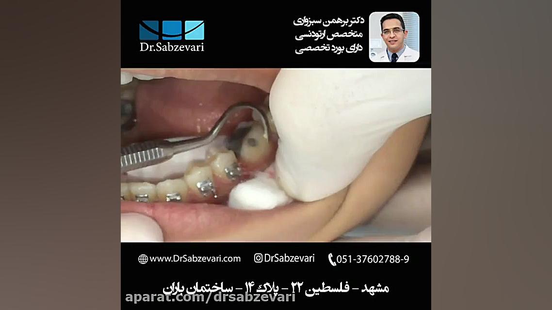 چسباندن بند (حلقه فلزی) ارتودنسی دکتر برهمن سبزواری - متخصص ارتودنسی - مشهد