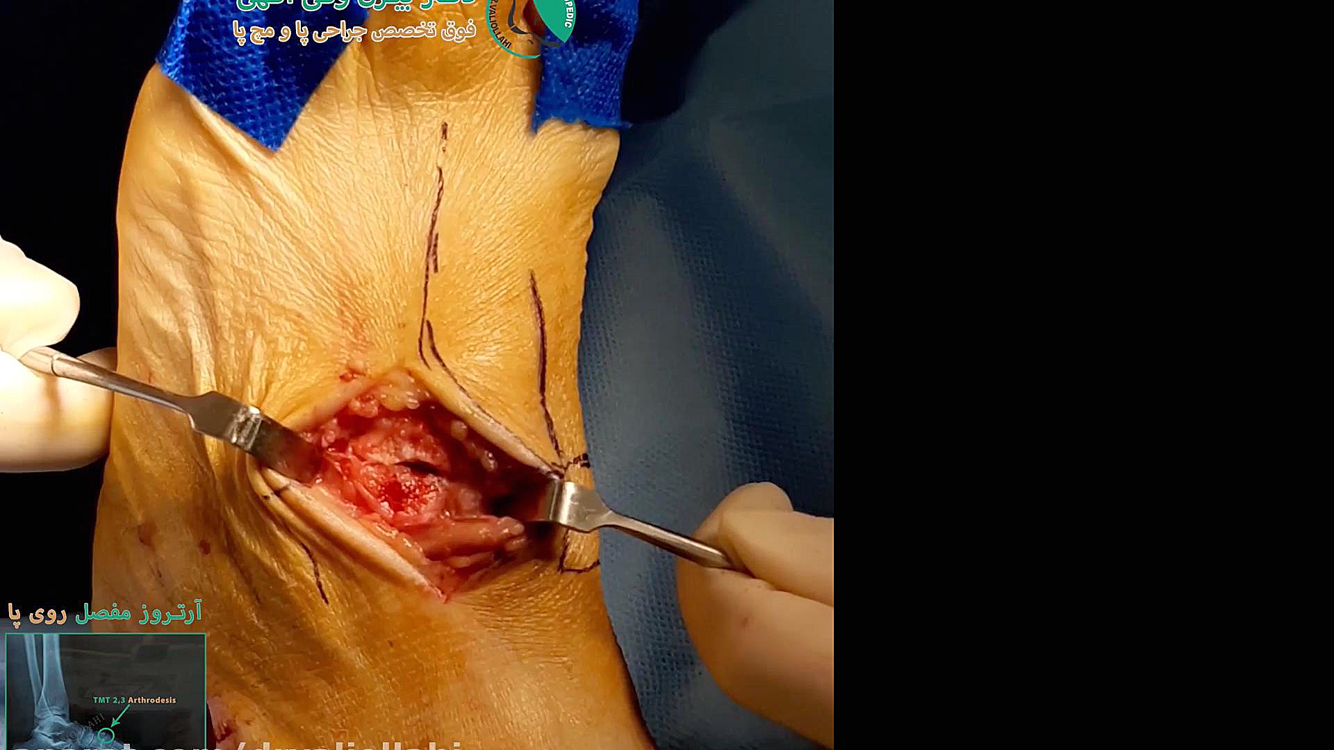 آرتروز مفصل روی پا _ TMT 2,3 Arthrodesis لیزر موهای زائد