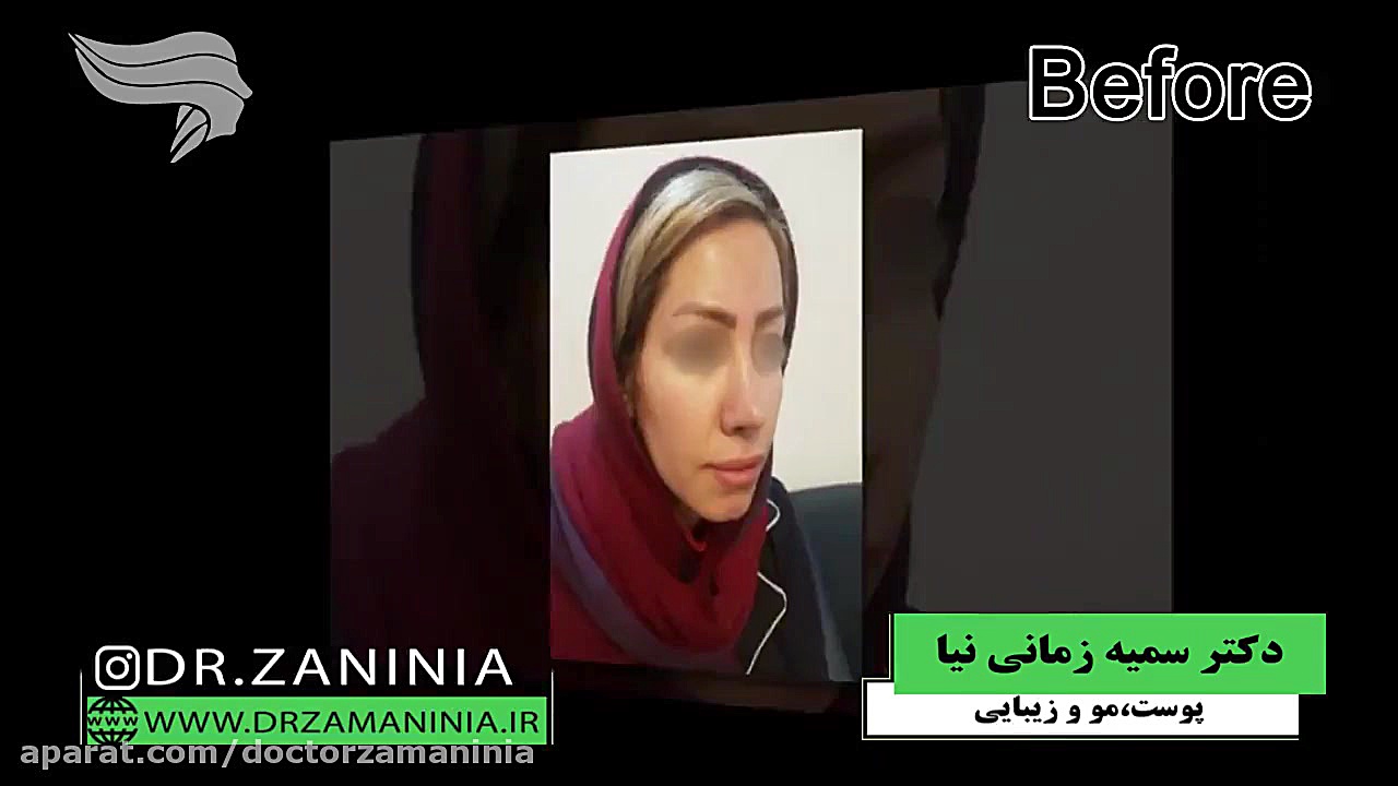 به روز ترین روش کاشت ابرو ویروس‌شناسی انسانی