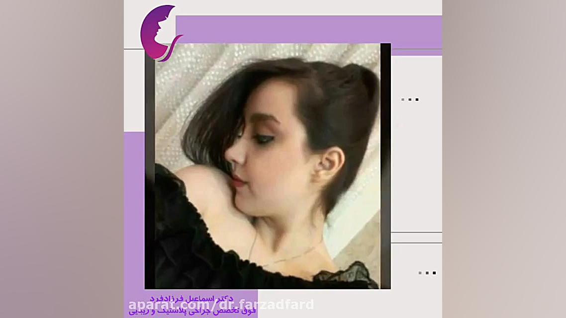 نمونه جراحی زیبایی بینی دکتر اسماعیل فرزاد فرد - فوق تخصص پلاستیک