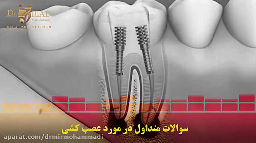 سوالات متداول در مورد عصب کشی دندان کالا دیجیتال