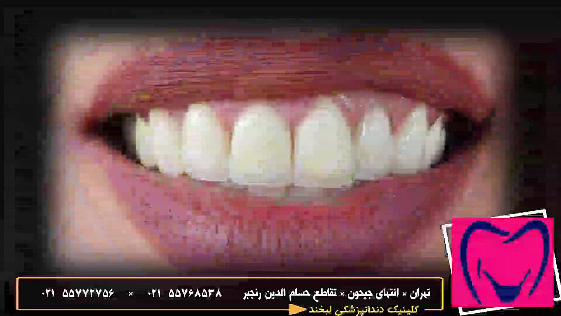 روکش دندان پلتفرم ارگانوئید انسانی