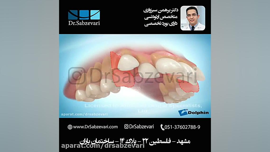ارتودنسی ثابت با کشیدن دندان دکتر برهمن سبزواری - متخصص ارتودنسی - مشهد
