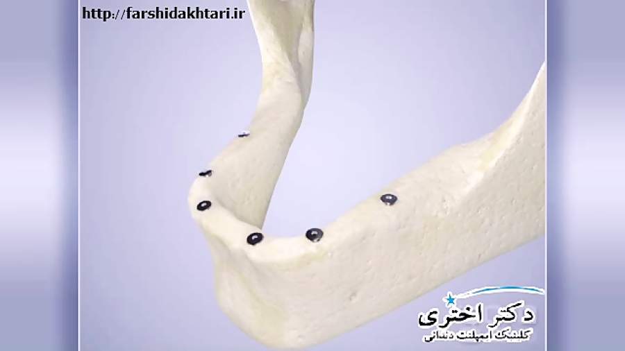 جایگزینی دندان مصنوعی با ایمپلنت دندان RNA Interference Assay