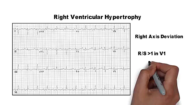 خلاصه فشرده آموزش خواندن Ecg یا Ekg الکتروکاردیوگرام دکتر مهدی صادقی